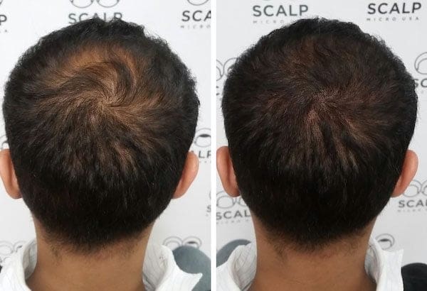 scalp micropigmentation density fill scalp micropigmentation density fill