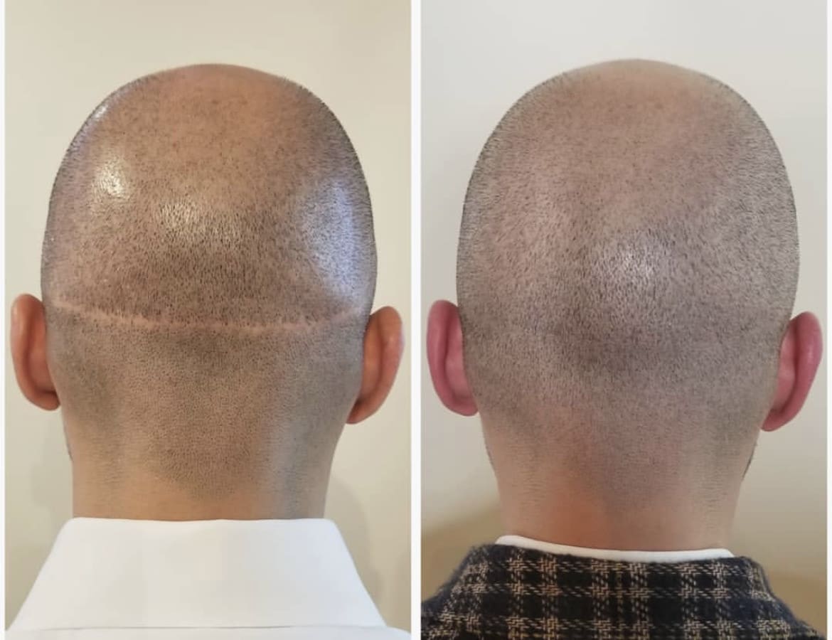 scalp micropigmentation scar camouflage scalp micropigmentation scar camouflage