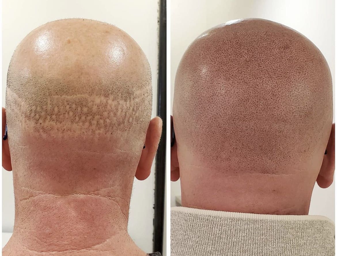 scalp pigmentation fue fut scar scalp pigmentation fue fut scar