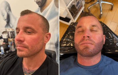 beard enhacement treatment