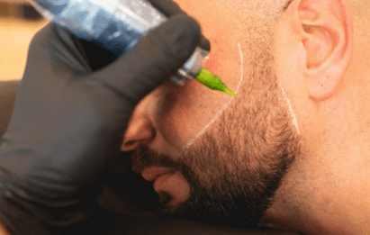 beard micropigmentation