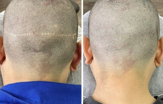Scar-camouflage-scalp-micropigmentation-fue-fut-tattoo-miami-los-angeles-chicago-nyc
