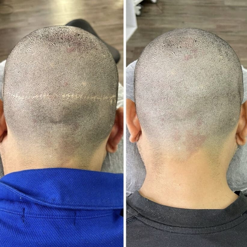 Scar-camouflage-scalp-micropigmentation-fue-fut-tattoo-miami-los-angeles-chicago-nyc