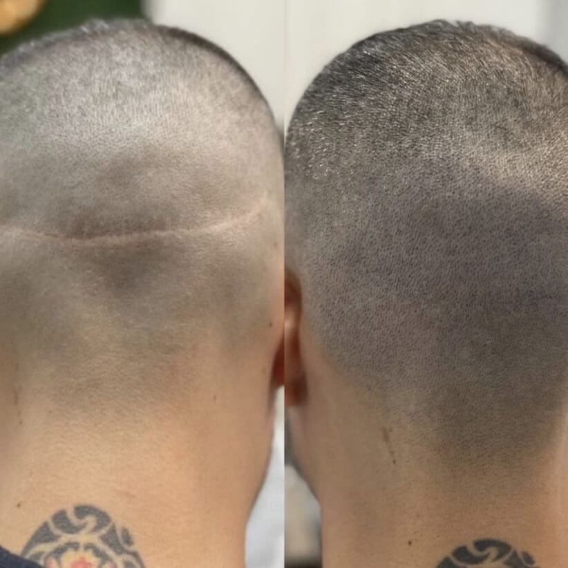 Scar-camouflage-scalp-micropigmentation-fut-tattoo-miami-los-angeles-chicago-nyc