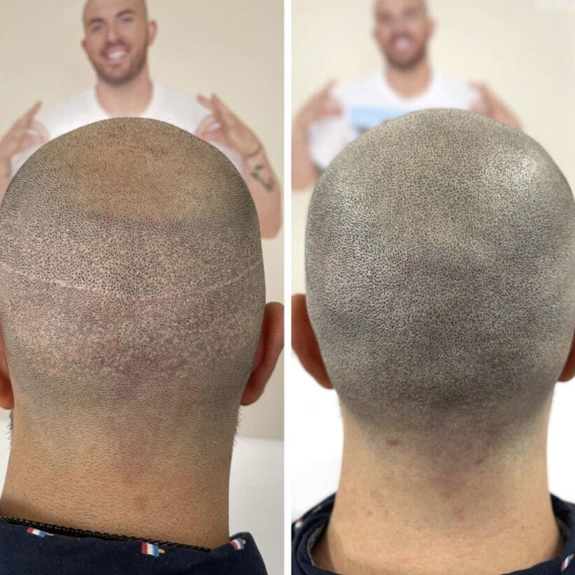 Scar-camouflage-scalp-micropigmentation-hairline-miami-los-angeles-chicago-nyc