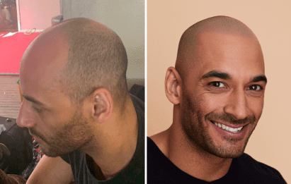scalp micropigmentation hairline