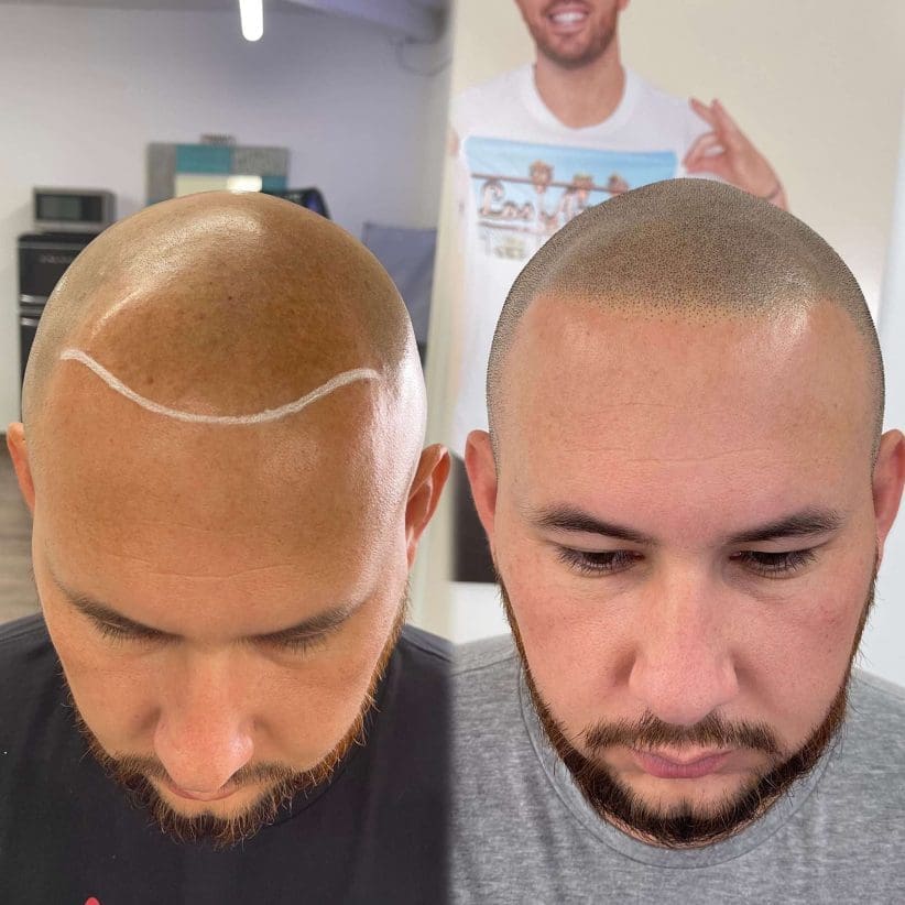 scalp micropigmentation los angeles brad