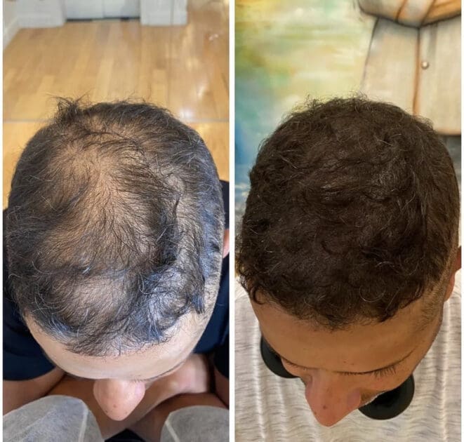 hair loss density fill
