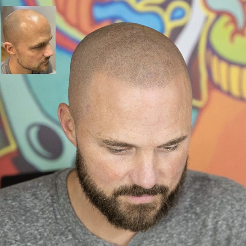 Scalp-micropigmentation-hair-loss-treatment-before-after-photo-micropigmentation-hair-tattoo-houston-texas-tx