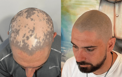 alopecia scalp micropigmentation