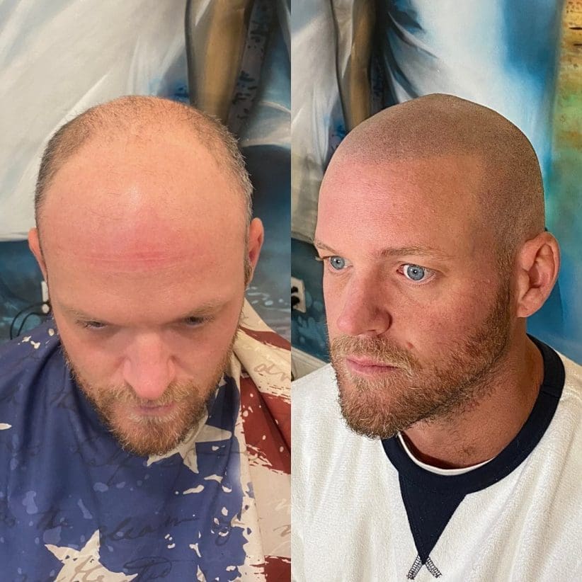 barber scalp micropigmentation
