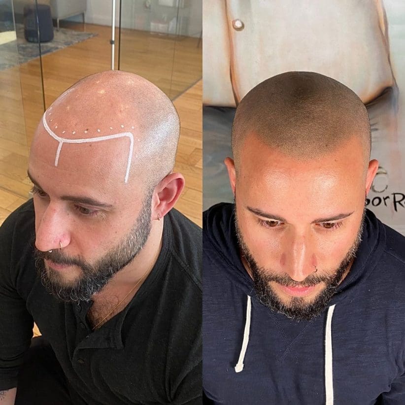 hair loss tattoo