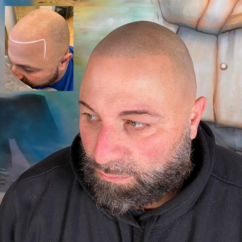 scalp micro pigmentation usa