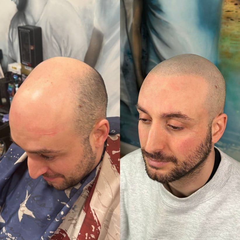 scalp micropigmentation