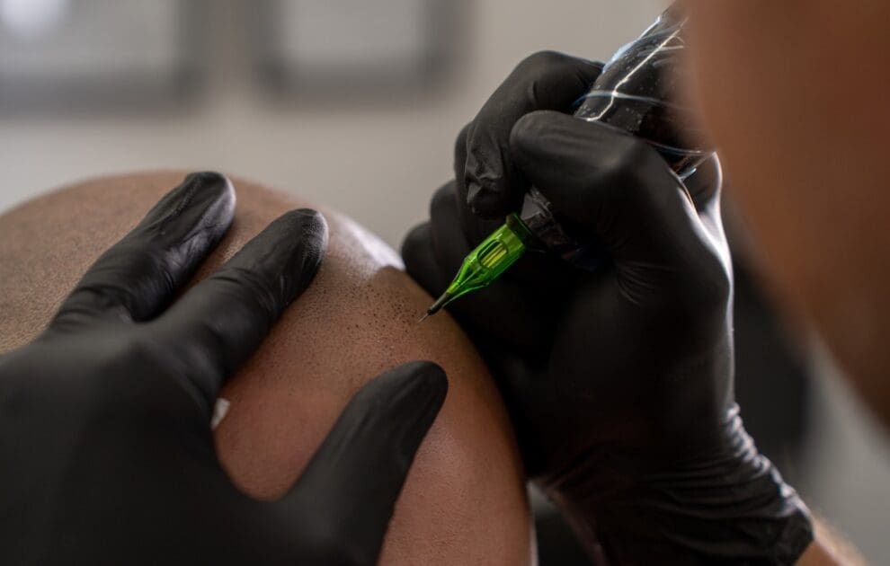 scalp micropigmentation hair loss