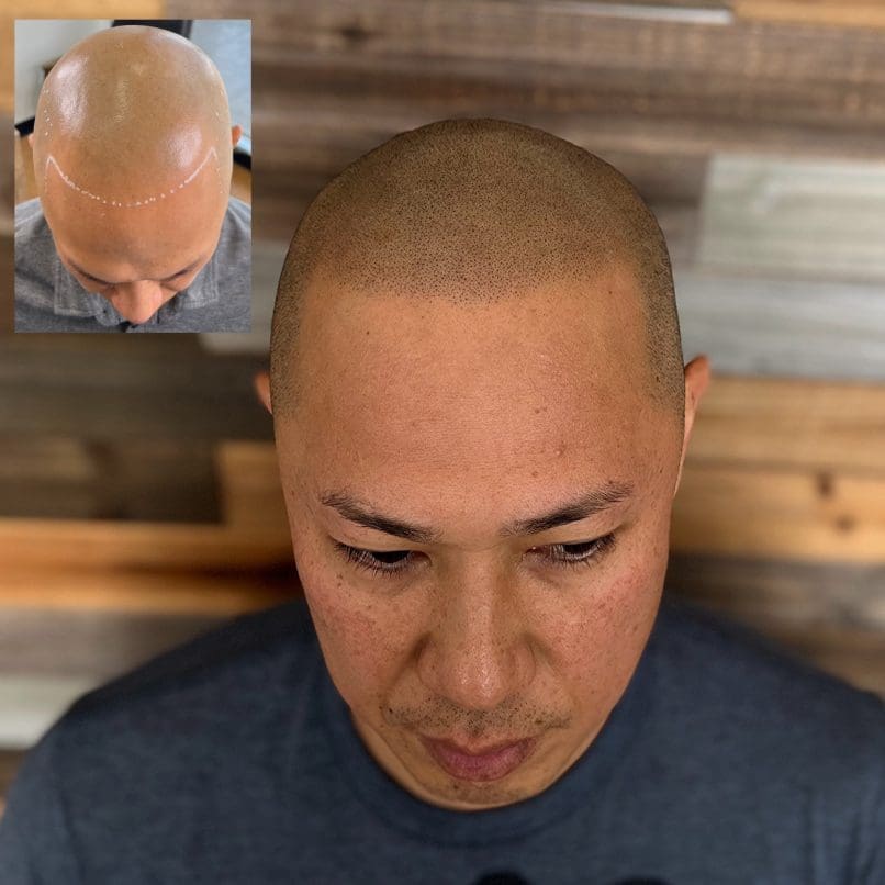 scalp micropigmentation houston texas