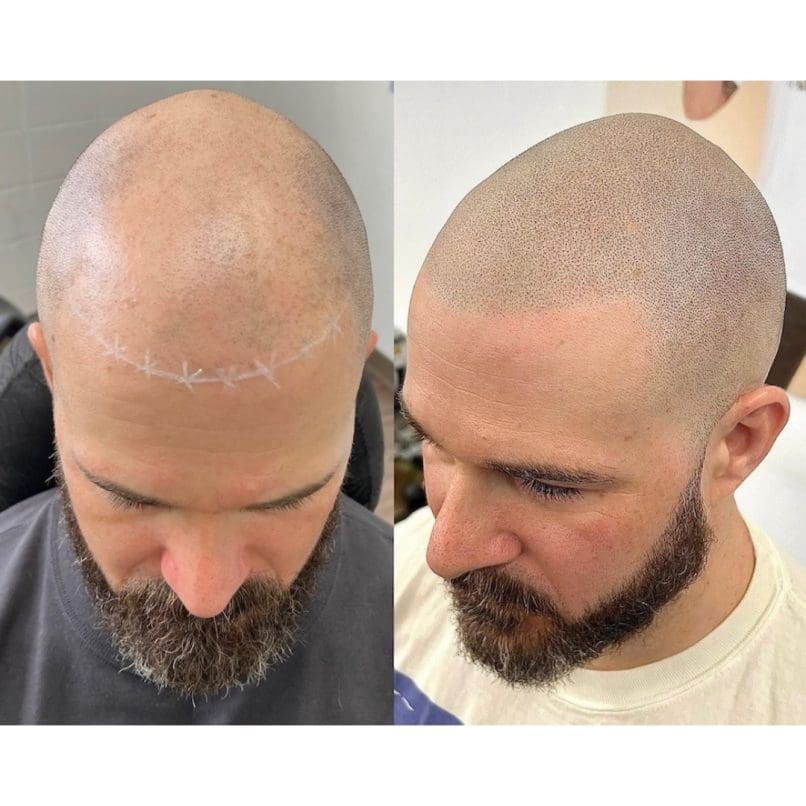 scalp micropigmentation los angeles