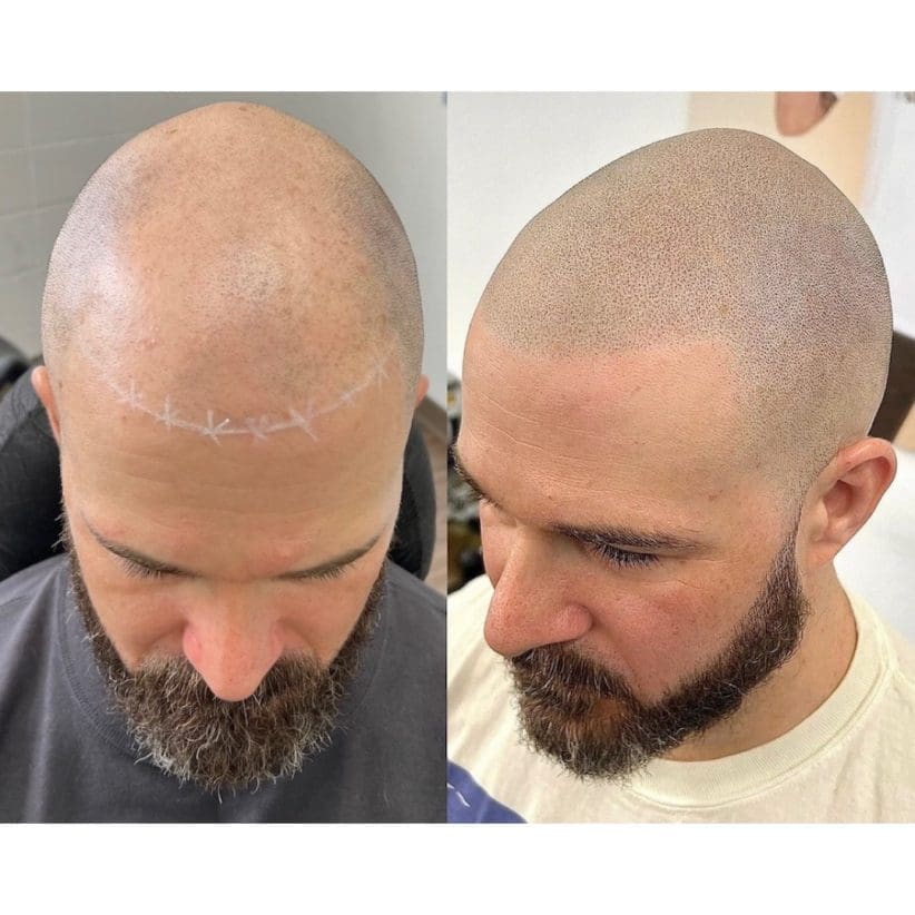 scalp micropigmentation los angeles