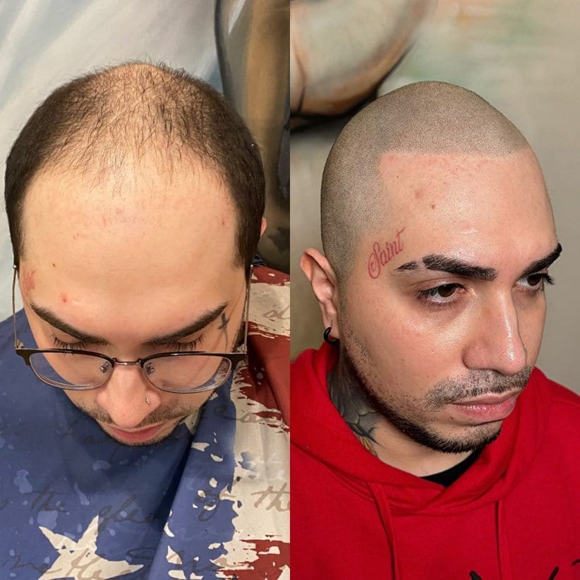 scalp tattoo florida