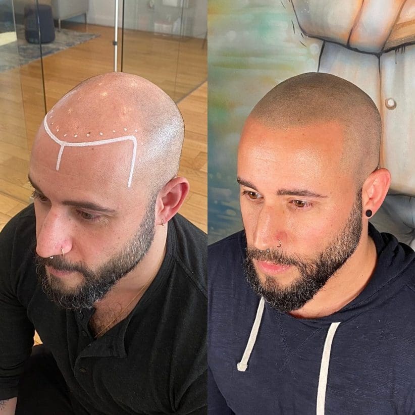 smp hair loss tattoo