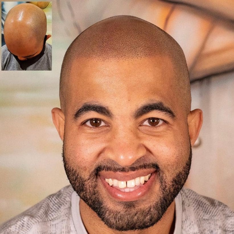 barber scalp micropigmentation