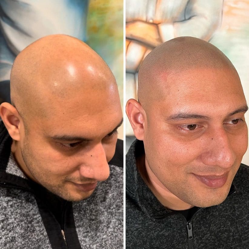 hair loss help