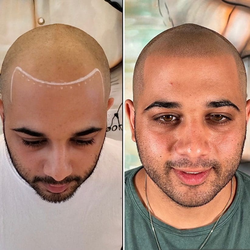 scalp micro pigmentation