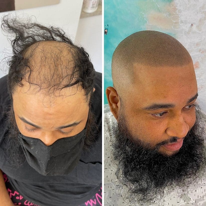 scalp micropigmentation