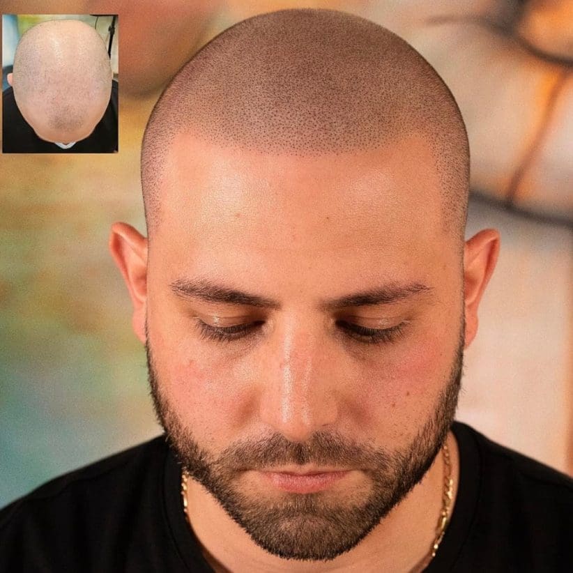 scalp micropigmentation los angeles new york houston chicago