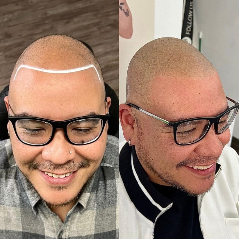 scalp micropigmentation near me