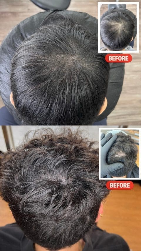 hair transplant and scalp micro