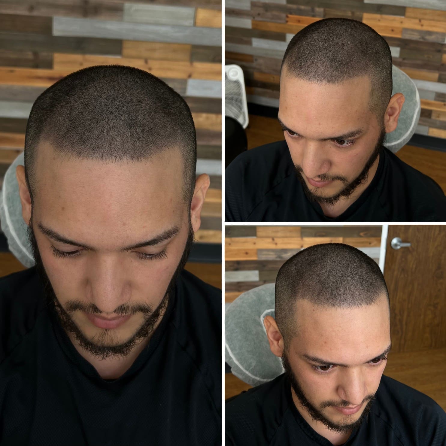 hair transplant with smp density fill