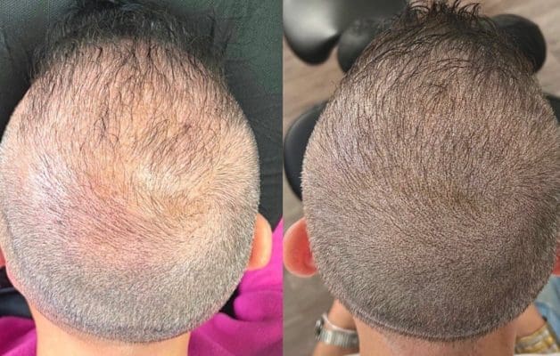 smp plus hair transplant add on